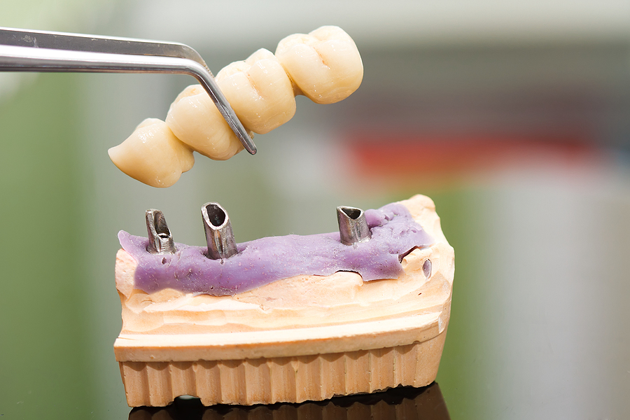 Benefits of Dental Implants
