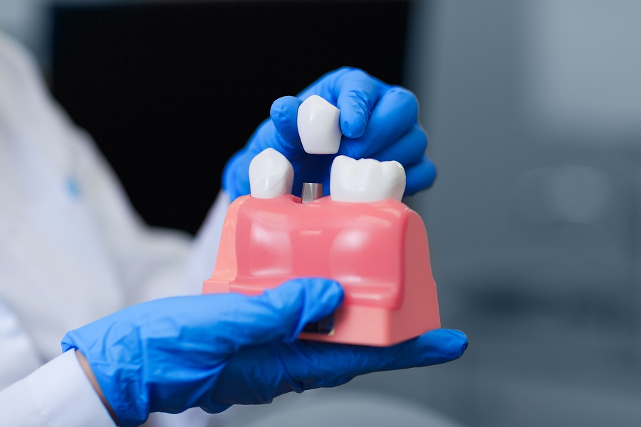 Get Dental Implants in a Day with Guided Implant Surgery